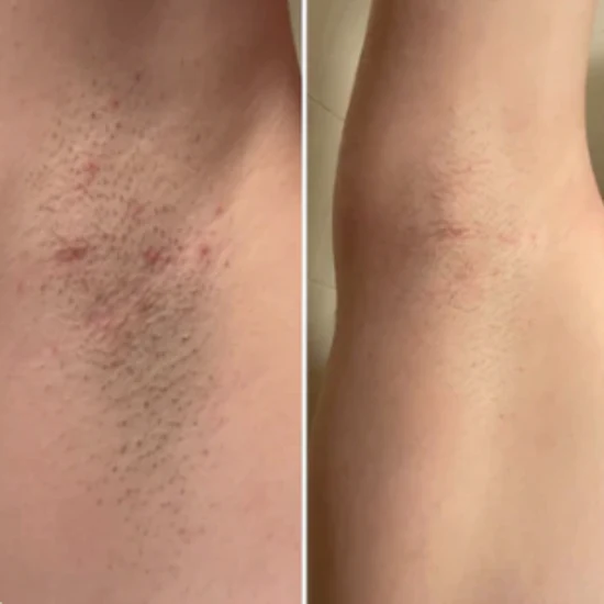 Antes / Después